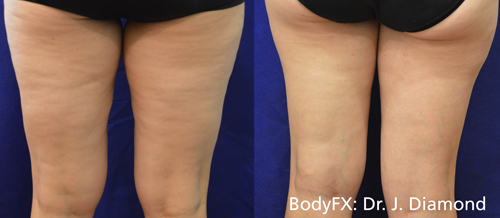 BodyFX Before & After