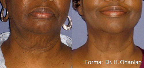 Forma Before & After