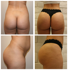 Brazilian Butt lift Before & After photos