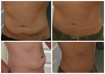 Bodytite Before & After