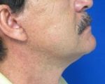 Male Face and Neck Lift