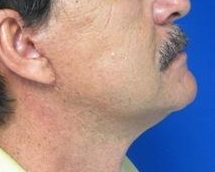 Male Face and Neck Lift before and after photos by Hughes Plastic Surgery in Los Angeles, CA