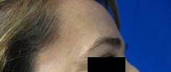 Brow Lift before and after photos by Hughes Plastic Surgery in Los Angeles, CA