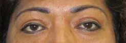 Eyelid Surgery before and after photos by Hughes Plastic Surgery in Los Angeles, CA