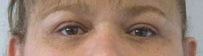 Eyelid Surgery before and after photos by Hughes Plastic Surgery in Los Angeles, CA