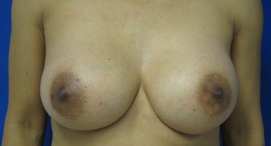 Breast Augmentation with Fat Grafting before and after photos by Hughes Plastic Surgery in Los Angeles, CA