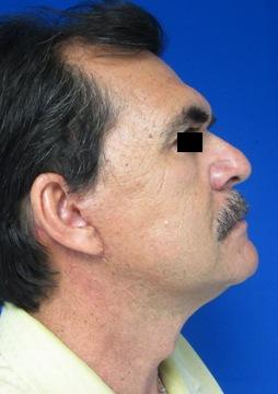Brow Lift before and after photos by Hughes Plastic Surgery in Los Angeles, CA