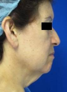 Facelift before and after photo by Hughes Plastic Surgery in Los Angeles, CA