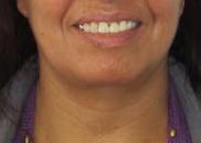Facelift before and after photo by Hughes Plastic Surgery in Los Angeles, CA