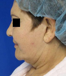 Neck Lift before and after photo by Hughes Plastic Surgery in Los Angeles, CA