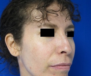 Rhinoplasty Surgery before and after photos by Hughes Plastic Surgery in Los Angeles, CA