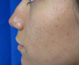 Rhinoplasty Surgery before and after photos by Hughes Plastic Surgery in Los Angeles, CA