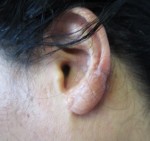 Ear Correction