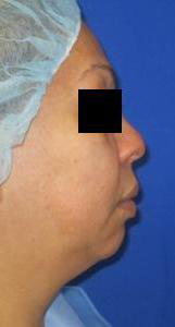 Chin Implant before and after photo by Hughes Plastic Surgery in Los Angeles, CA