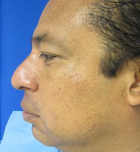 Chin Implant before and after photo by Hughes Plastic Surgery in Los Angeles, CA