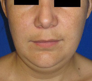 Chin Liposuction before and after photos by Hughes Plastic Surgery in Los Angeles, CA