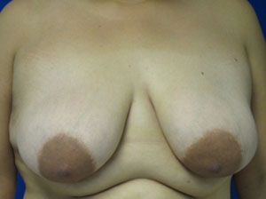 Breast Augmentation and Lift before and after photos by Hughes Plastic Surgery in Los Angeles, CA