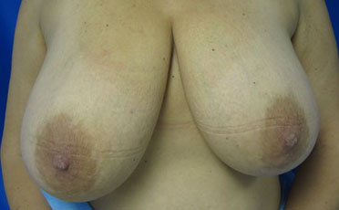 Breast Reduction before and after photos by Hughes Plastic Surgery in Los Angeles, CA
