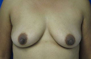 Breast Augmentation Revision before and after photos by Hughes Plastic Surgery in Los Angeles, CA