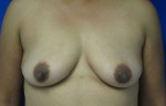 Breast Reconstruction and Breast Deformity Correction