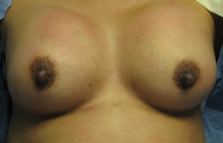 Breast Reconstruction and Breast Deformity Correction before and after photos by Hughes Plastic Surgery in Los Angeles, CA