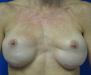 Breast Reconstruction and Breast Deformity Correction before and after photos by Hughes Plastic Surgery in Los Angeles, CA
