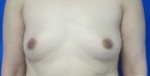 Inverted Nipple Correction