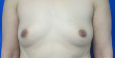 Inverted Nipple Correction before and after photos by Hughes Plastic Surgery in Los Angeles, CA