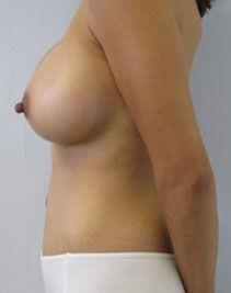Mommy Makeover before and after photo by Hughes Plastic Surgery in Los Angeles, CA
