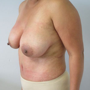 Mommy Makeover before and after photo by Hughes Plastic Surgery in Los Angeles, CA