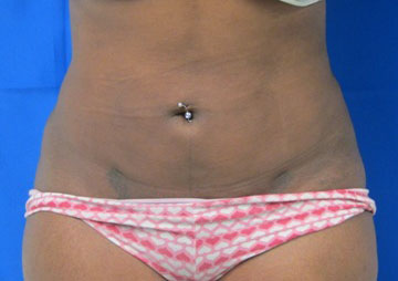 Liposuction before and after photo by Hughes Plastic Surgery in Los Angeles, CA