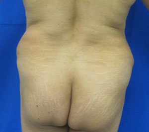 Liposuction before and after photo by Hughes Plastic Surgery in Los Angeles, CA