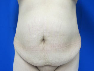 Tummy Tuck before and after photo by Hughes Plastic Surgery in Los Angeles, CA