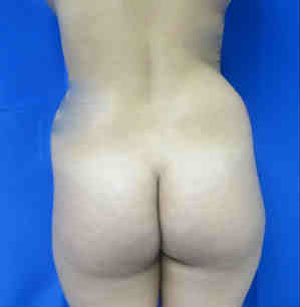 Brazilian Butt Lift before and after photo by Hughes Plastic Surgery in Los Angeles, CA