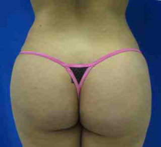 Butt Implants Case 4703 After Photo