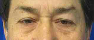 Male Eyelid Surgery before and after photos by Hughes Plastic Surgery in Los Angeles, CA
