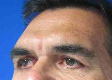 Male Eyelid Surgery before and after photos by Hughes Plastic Surgery in Los Angeles, CA