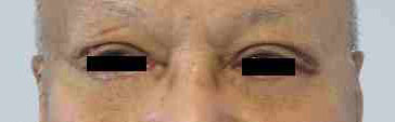 Male eyelid surgery before and after photos by Hughes Plastic Surgery in Los Angeles, CA