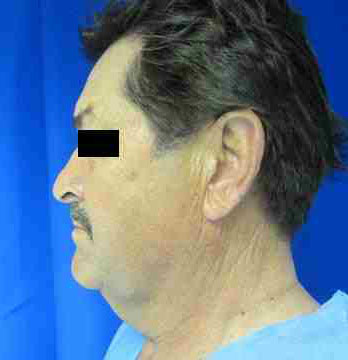 Male Face and Neck Lift before and after photos by Hughes Plastic Surgery in Los Angeles, CA