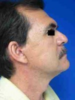 Male Face and Neck Lift