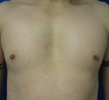 Male Pec Implants before and after photos by Hughes Plastic Surgery in Los Angeles, CA