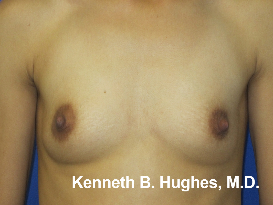Breast Augmentation (Implants) before and after photo by Hughes Plastic Surgery in Los Angeles, CA