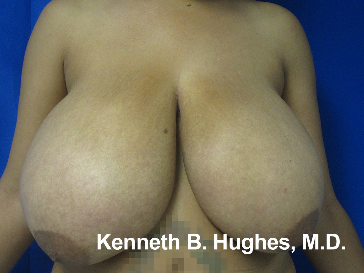 Breast Reduction and lift before and after photos by Hughes Plastic Surgery in Los Angeles, CA