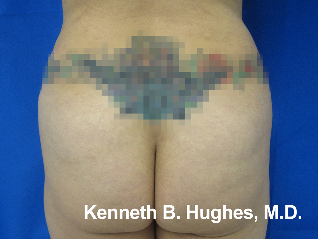 Butt Implants Case 4962 Before Photo