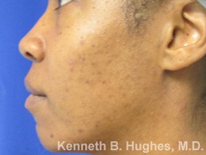 Facial Fat Grafting and Chin Implant before and after photos by Hughes Plastic Surgery in Los Angeles, CA