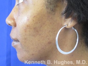 Facial Fat Grafting and Chin Implant before and after photos by Hughes Plastic Surgery in Los Angeles, CA