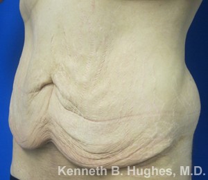 Male Tummy Tuck before and after photos by Hughes Plastic Surgery in Los Angeles, CA