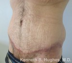 Male Tummy Tuck
