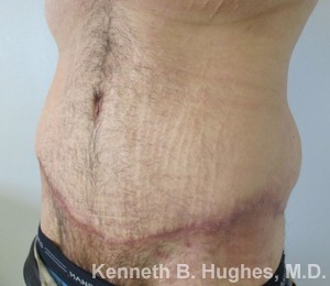 Male Tummy Tuck before and after photos by Hughes Plastic Surgery in Los Angeles, CA