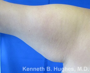 Arm Lift before and after photos by Hughes Plastic Surgery in Los Angeles, CA